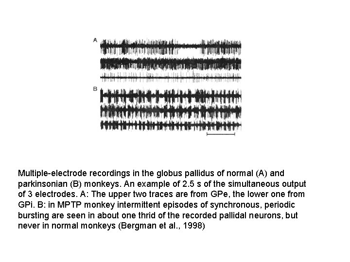 Multiple-electrode recordings in the globus pallidus of normal (A) and parkinsonian (B) monkeys. An