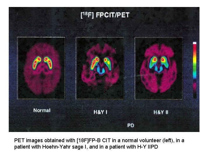 PET images obtained with [18 F]FP-B CIT in a normal volunteer (left), in a