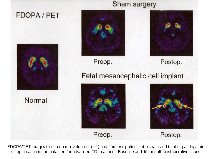 FDOPA/PET images from a normal volunteer (left) and from two patients of a sham