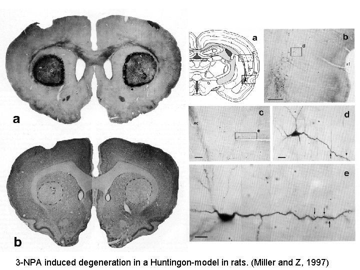 3 -NPA induced degeneration in a Huntingon-model in rats. (Miller and Z, 1997) 