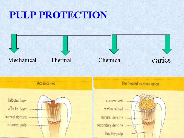 PULP PROTECTION Mechanical Thermal Chemical caries 