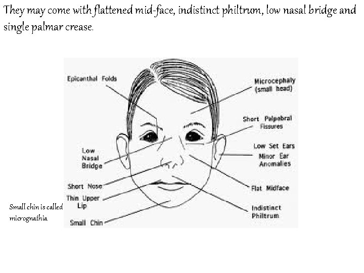 They may come with flattened mid-face, indistinct philtrum, low nasal bridge and single palmar