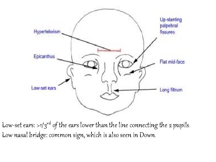 Low-set ears: >1/3 rd of the ears lower than the line connecting the 2