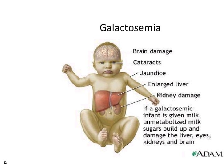 Galactosemia 22 