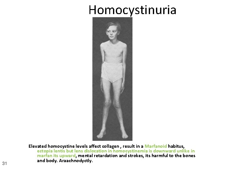Homocystinuria 31 Elevated homocystine levels affect collagen , result in a Marfanoid habitus, ectopia