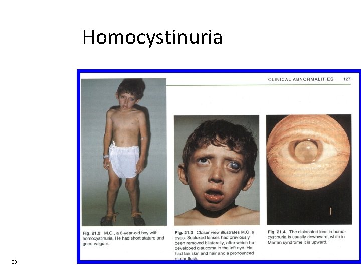 Homocystinuria 33 