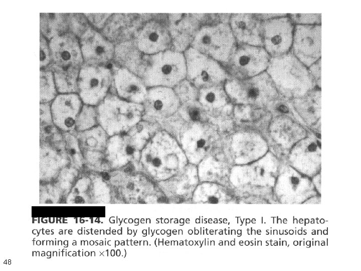 Von Gierke Disease 48 