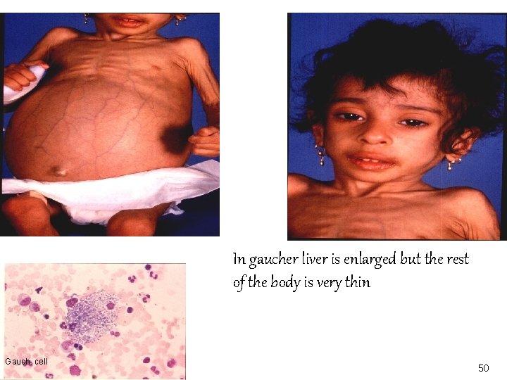 In gaucher liver is enlarged but the rest of the body is very thin