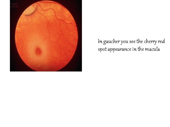 In gaucher you see the cherry red spot appearance in the macula 