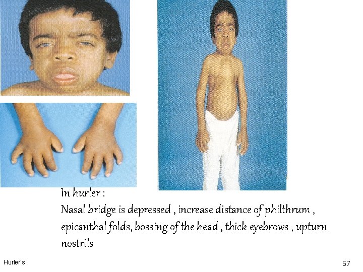 In hurler : Nasal bridge is depressed , increase distance of philthrum , epicanthal