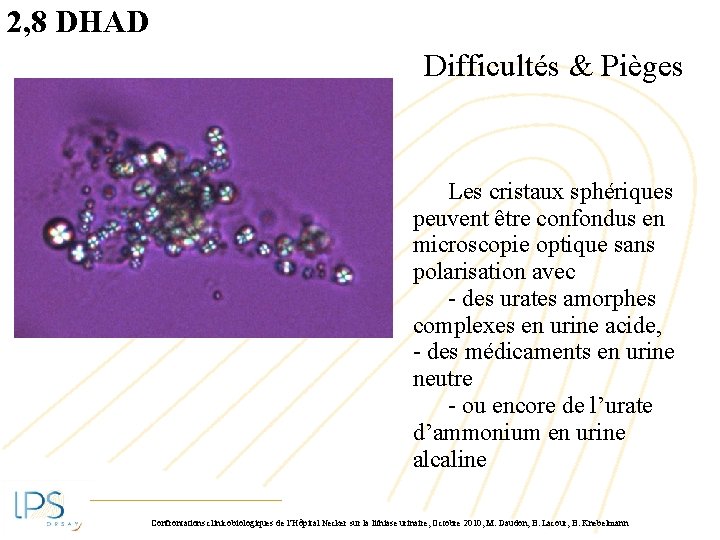 2, 8 DHAD Difficultés & Pièges Les cristaux sphériques peuvent être confondus en microscopie