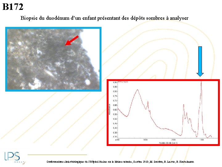 B 172 Biopsie du duodénum d’un enfant présentant des dépôts sombres à analyser Confrontations