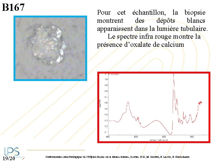 B 167 19/20 Pour cet échantillon, la biopsie montrent des dépôts blancs apparaissent dans