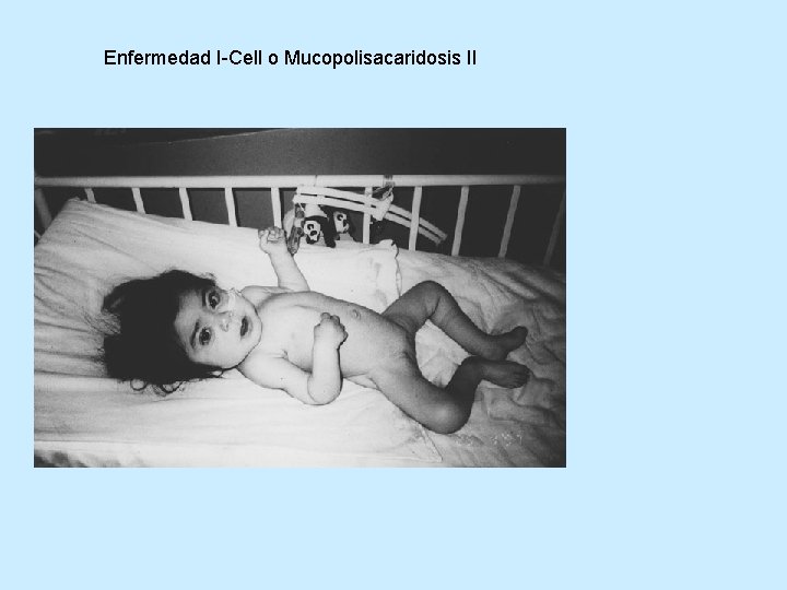 Enfermedad I-Cell o Mucopolisacaridosis II 