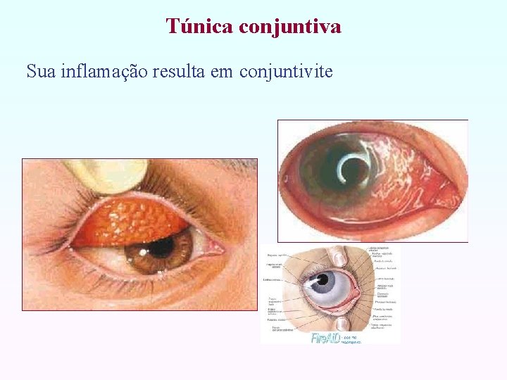 Túnica conjuntiva Sua inflamação resulta em conjuntivite 