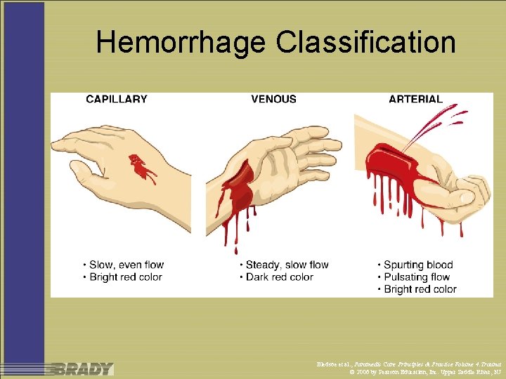 Hemorrhage Classification Bledsoe et al. , Paramedic Care Principles & Practice Volume 4: Trauma