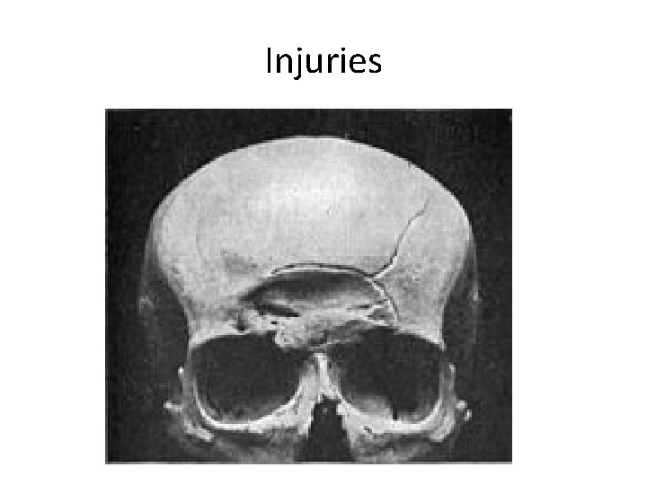 Injuries Femur 