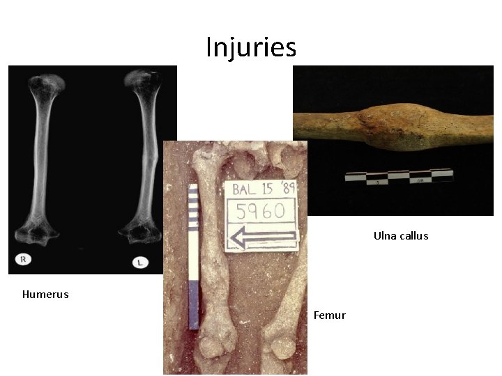 Injuries Ulna callus Humerus Femur 