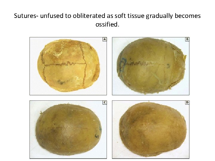 Sutures- unfused to obliterated as soft tissue gradually becomes ossified. 