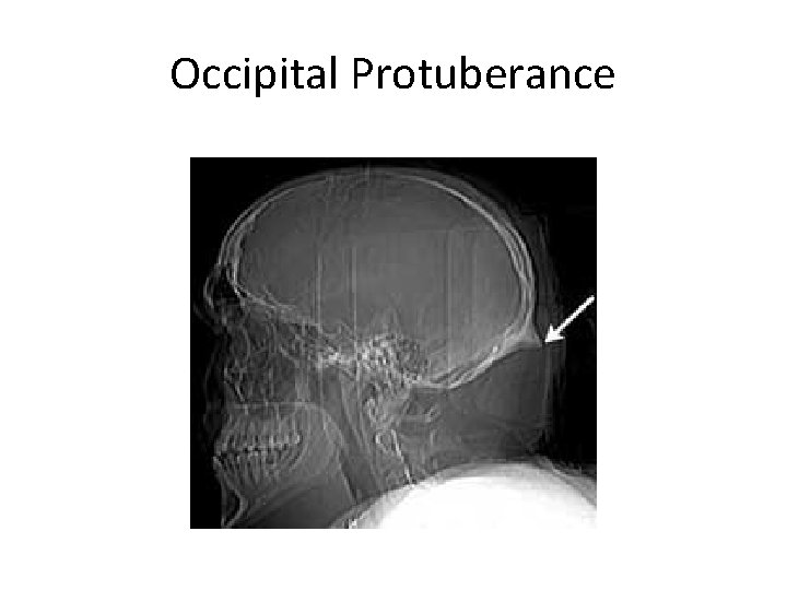 Occipital Protuberance 