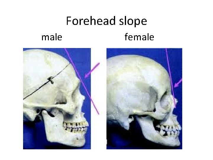 Forehead slope male female 