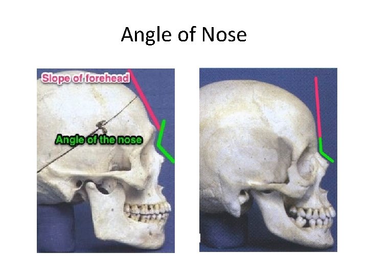Angle of Nose 