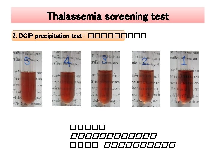 Thalassemia screening test 2. DCIP precipitation test : �������� ���������� 
