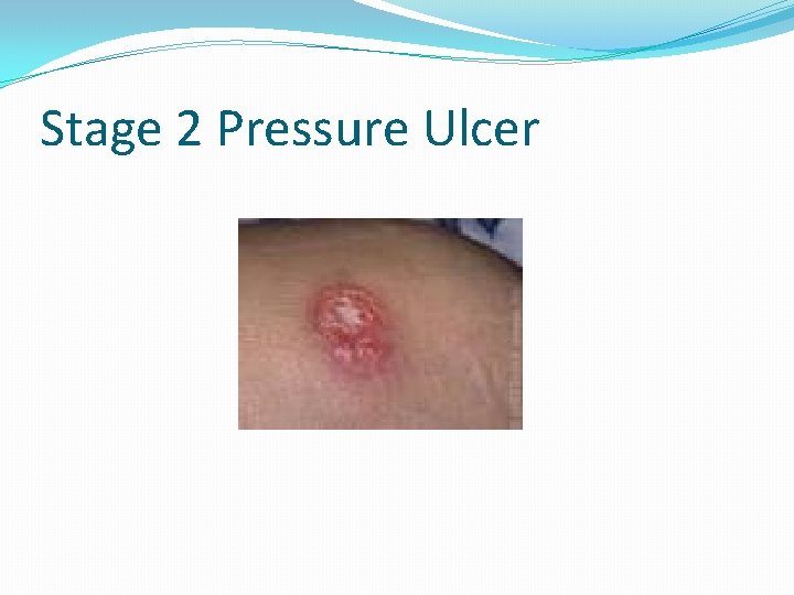 Stage 2 Pressure Ulcer 