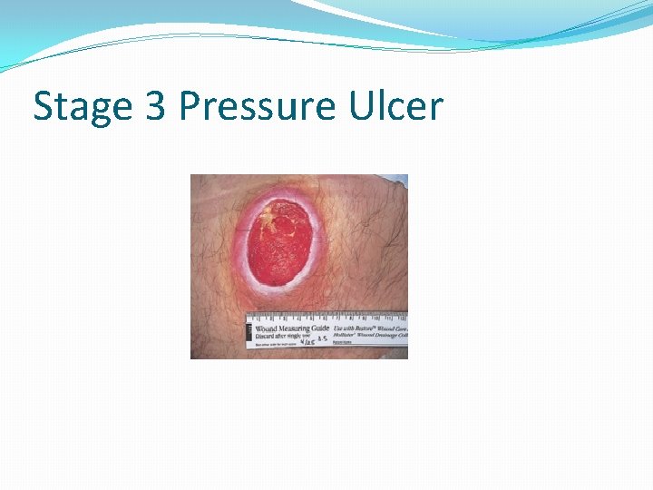 Stage 3 Pressure Ulcer 