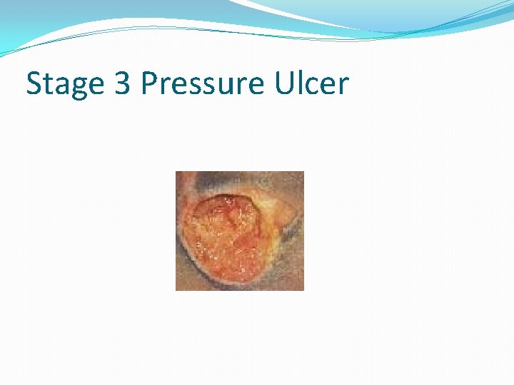 Stage 3 Pressure Ulcer 