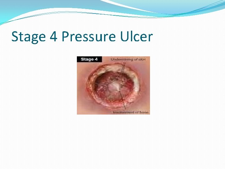 Stage 4 Pressure Ulcer 