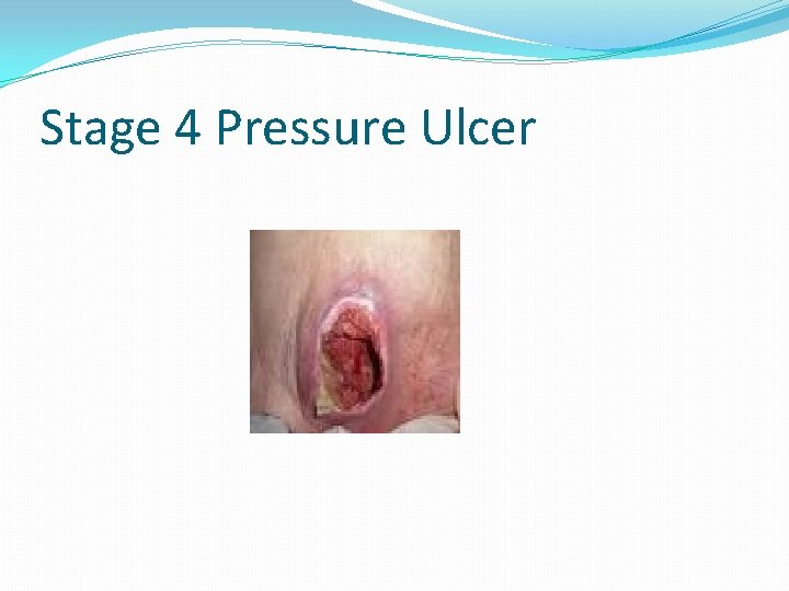 Stage 4 Pressure Ulcer 