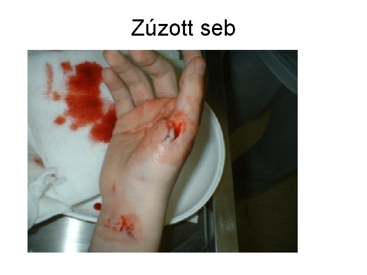 Zúzott seb 