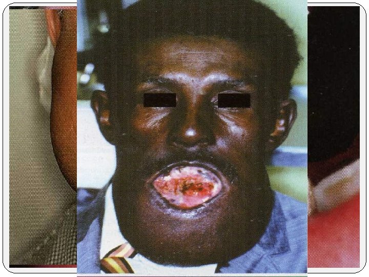 A painless swelling expansion of the jaw is the usual clinical presentation If untreated,