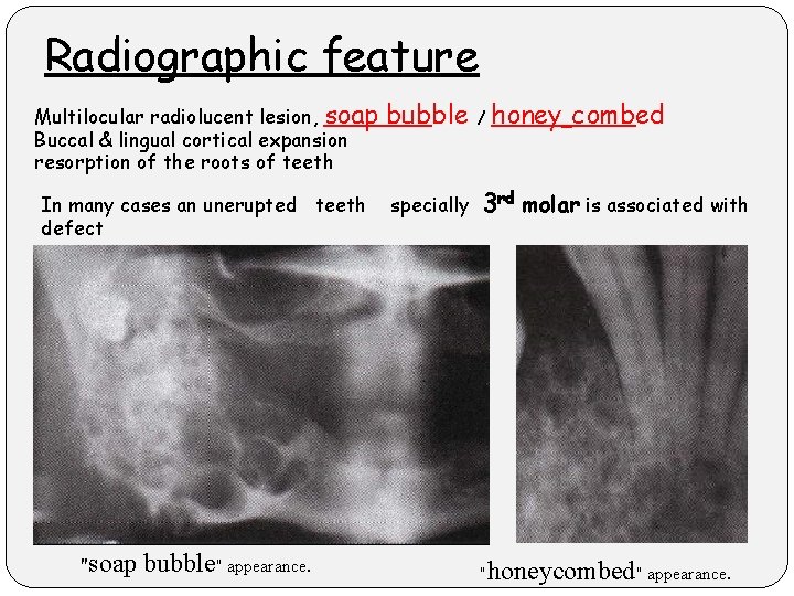 Radiographic feature Multilocular radiolucent lesion, soap Buccal & lingual cortical expansion resorption of the