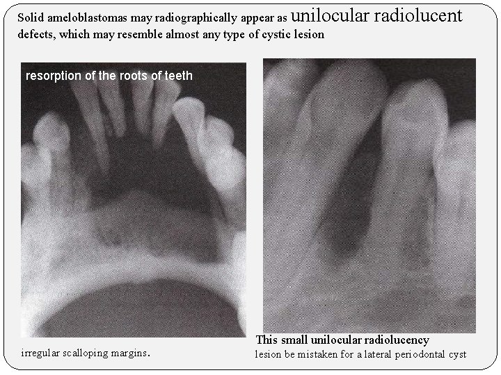 Solid ameloblastomas may radiographically appear as unilocular defects, which may resemble almost any type