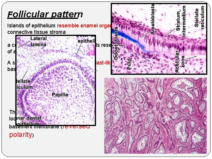 Follicular pattern Islands of epithelium resemble enamel organ epithelium in a mature fibrous connective