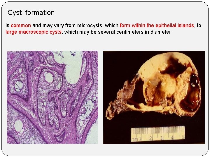 Cyst formation is common and may vary from microcysts, which form within the epithelial