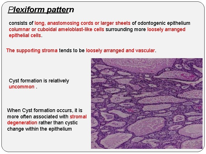 Plexiform pattern consists of long, anastomosing cords or larger sheets of odontogenic epithelium columnar