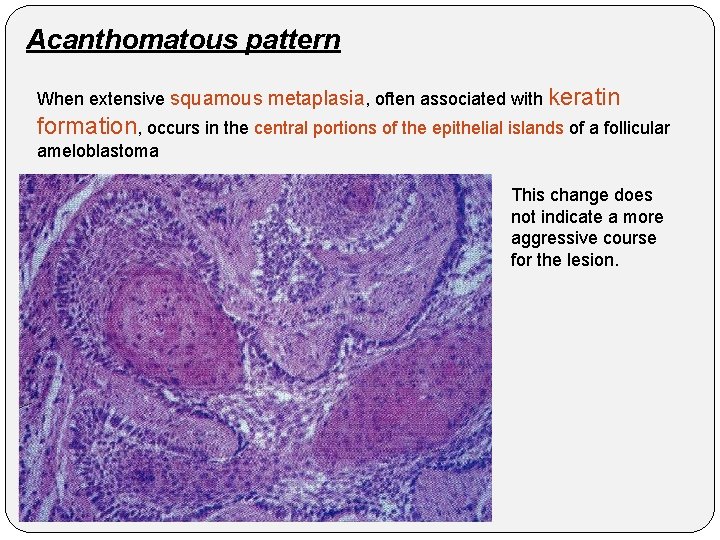 Acanthomatous pattern When extensive squamous metaplasia, often associated with keratin formation, occurs in the