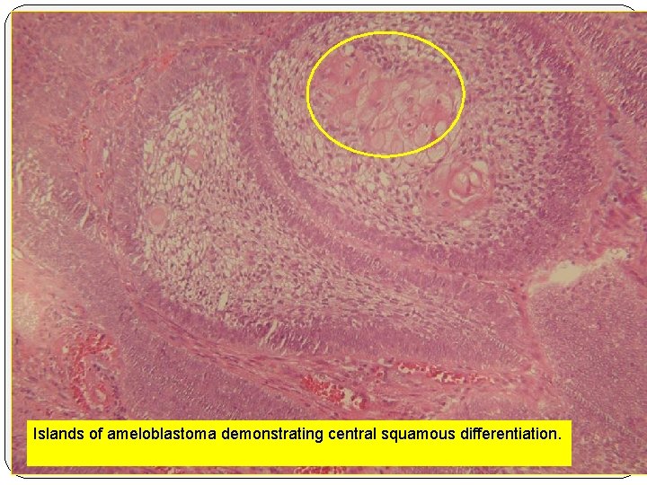Islands of ameloblastoma demonstrating central squamous differentiation. 