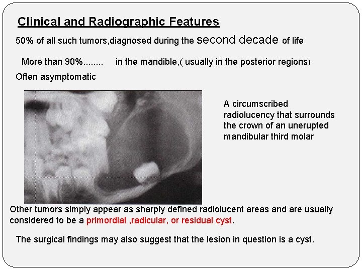 Clinical and Radiographic Features 50% of all such tumors, diagnosed during the second decade