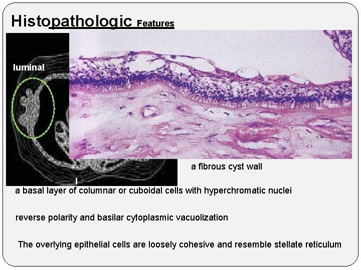 Histopathologic Features luminal a fibrous cyst wall l a basal layer of columnar or