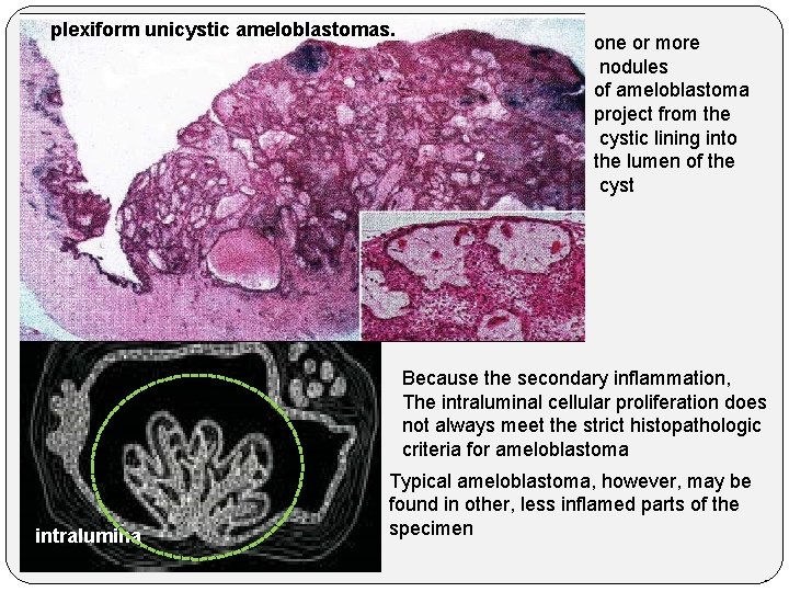 plexiform unicystic ameloblastomas. one or more nodules of ameloblastoma project from the cystic lining
