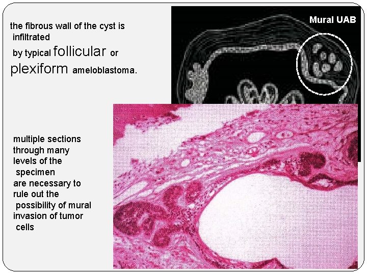 the fibrous wall of the cyst is infiltrated by typical follicular or plexiform ameloblastoma.