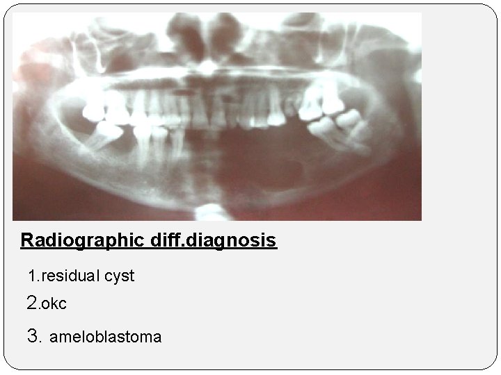 Radiographic diff. diagnosis 1. residual cyst 2. okc 3. ameloblastoma 