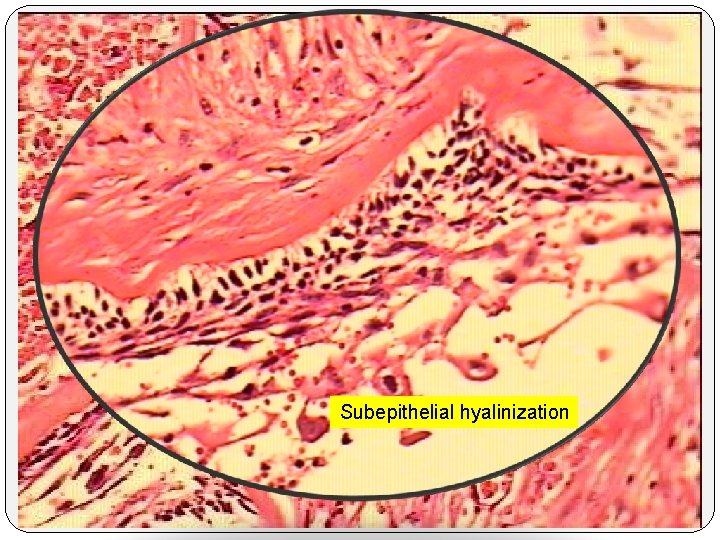 Subepithelial hyalinization 
