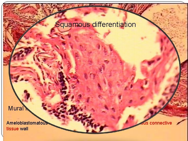 Squamous differentiation Mural invasion of tumor cells Ameloblastomatous invasion into the underlying mature collagenous