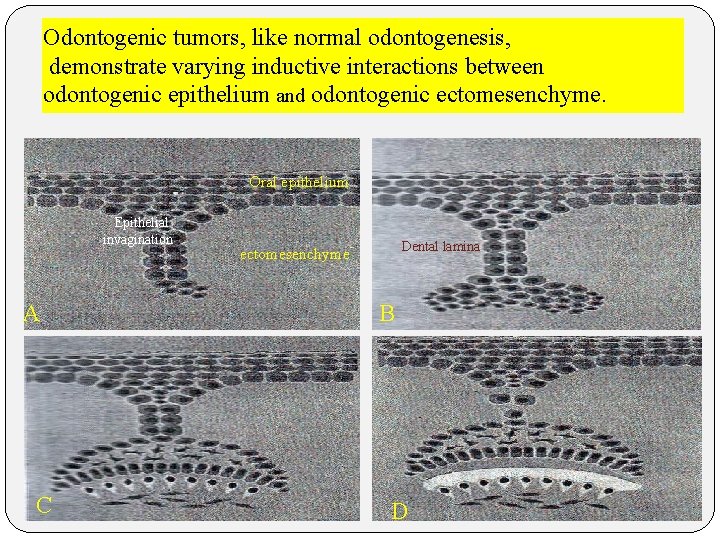 Odontogenic tumors, like normal odontogenesis, demonstrate varying inductive interactions between odontogenic epithelium and odontogenic
