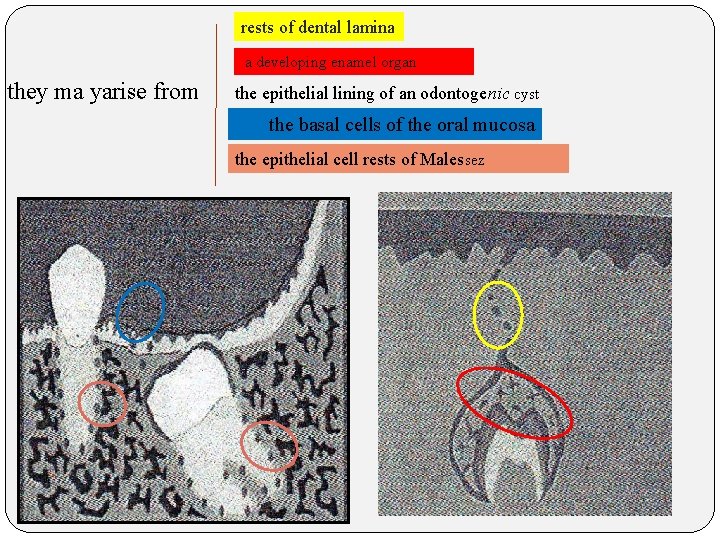 rests of dental lamina a developing enamel organ they ma yarise from the epithelial